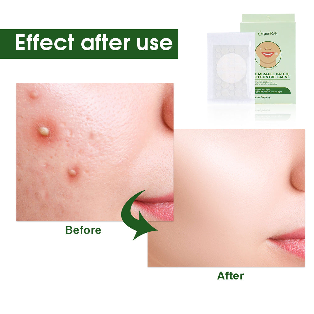 Acne Pimple Patch