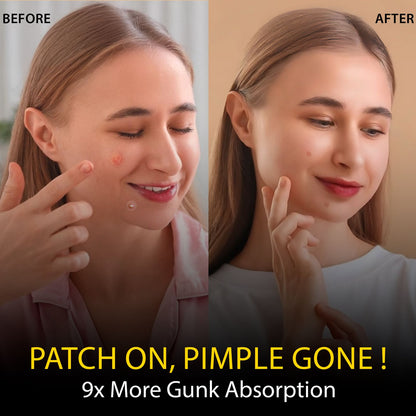 Acne Pimple Patch
